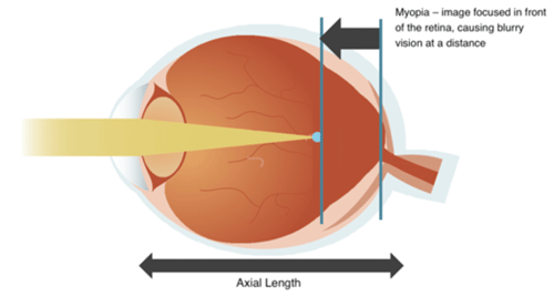 Blog-Myopia-Pervasive-Chart-2