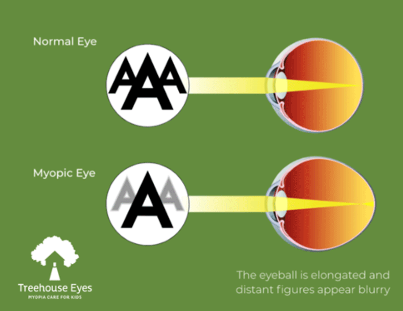 Blog-Myopia-Pervasive-Chart